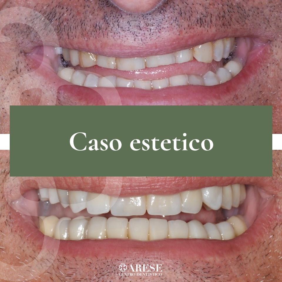 Centro Dentistico Arese - Caso estetico