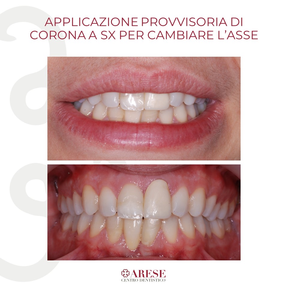 applicazione provvisoria