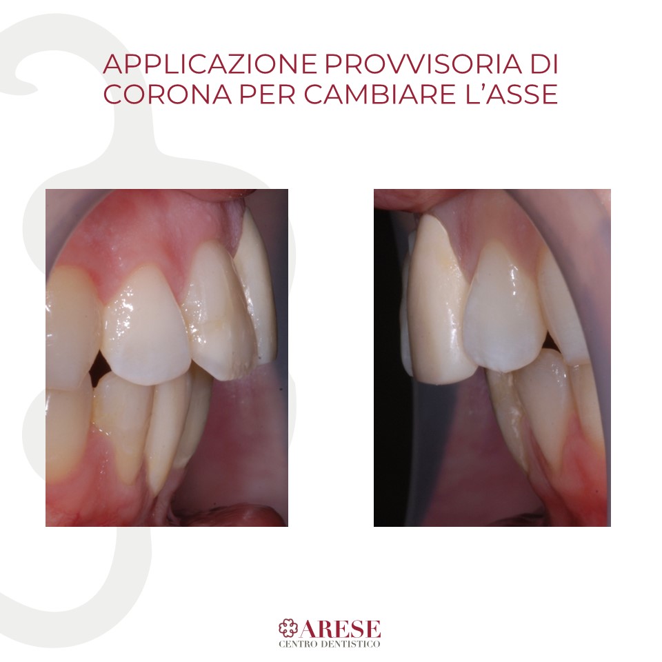 applicazione provvisoria