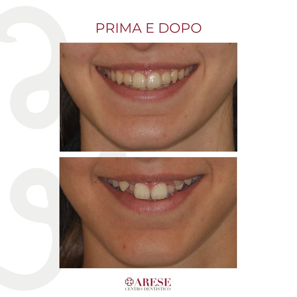 prima e dopo caso ortodontico